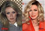 Donna Mills' Plastic Surgery Journey Revealed