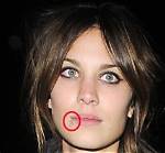 Famous Faces: Celebs with Cold Sores