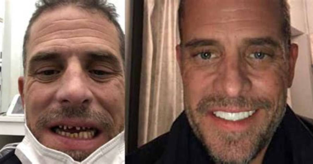 Hunter Biden's Teeth Transformation: a Comprehensive Review
