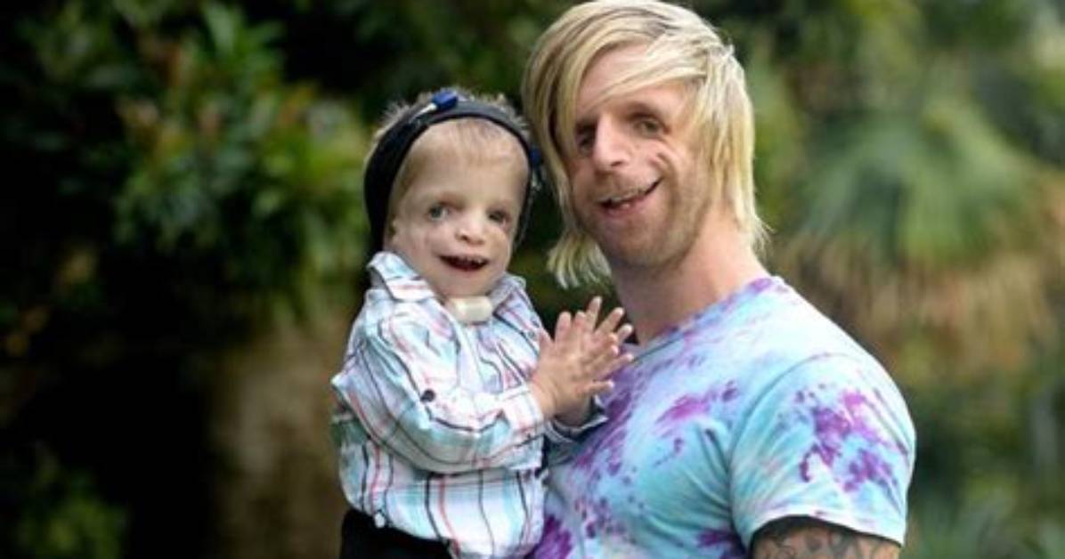 Inspiring Lives: Famous People with Treacher Collins Syndrome