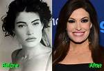 Kimberly Guilfoyle's Surgery: Before and After