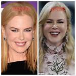 Nicole Kidman: a Journey Through Recovery After Surgery