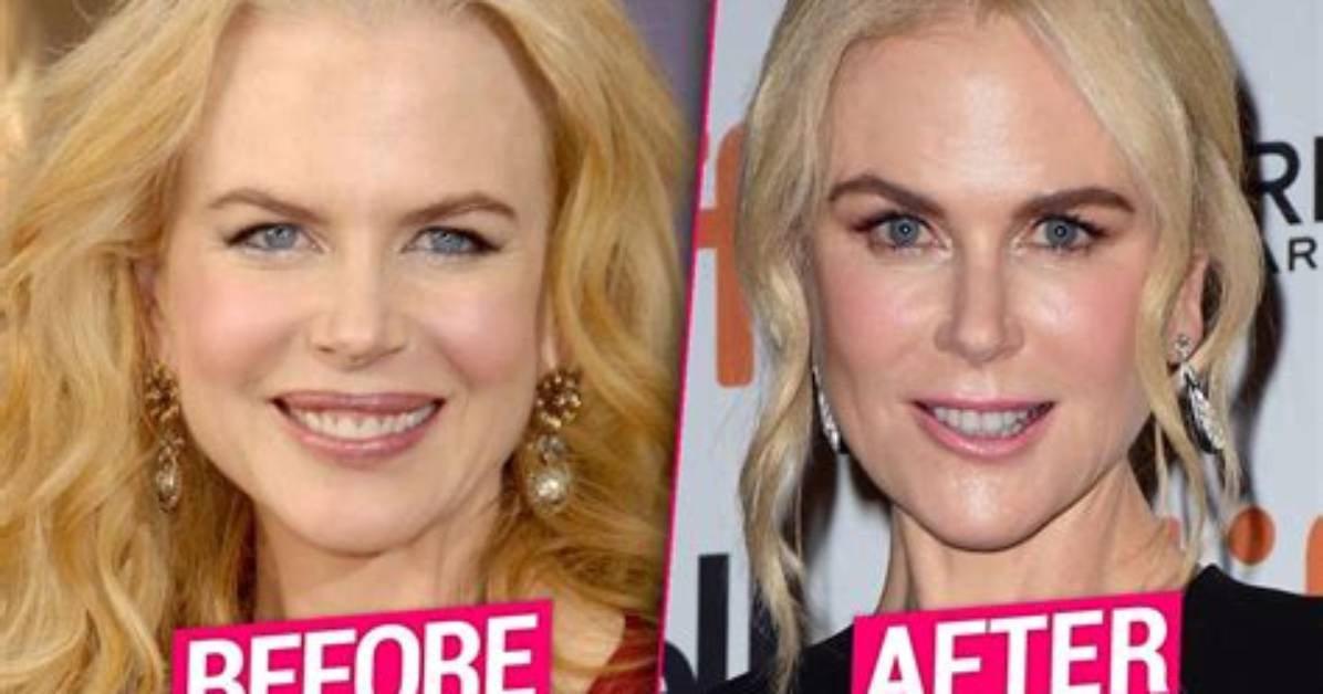 Nicole Kidman's Recent Plastic Surgery Transformation: Unveiling the Secrets