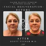Plastic Surgery Redefined in Winston-Salem, Nc