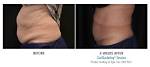 Results Gone Wrong: Cool Sculpting Before and After