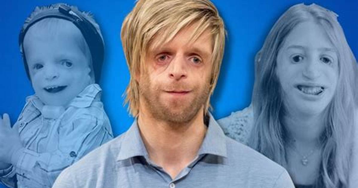 Shining Bright: Actors with Treacher Collins Syndrome