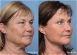 Susan Page's Facelift: Before and After Photos
