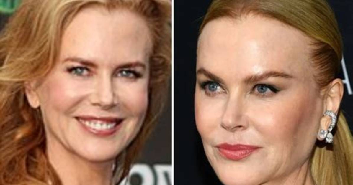 The Intriguing Truth: Nicole Kidman's Plastic Surgery Journey