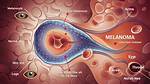 Understanding Melanoma: a Comprehensive Guide to Skin Cancer