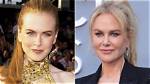 Unveiling the Truth: Did Nicole Kidman Get Botox?