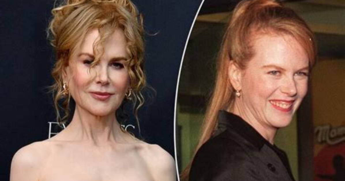 Woman, 54, Looks Like Nicole Kidman After Getting Surgery